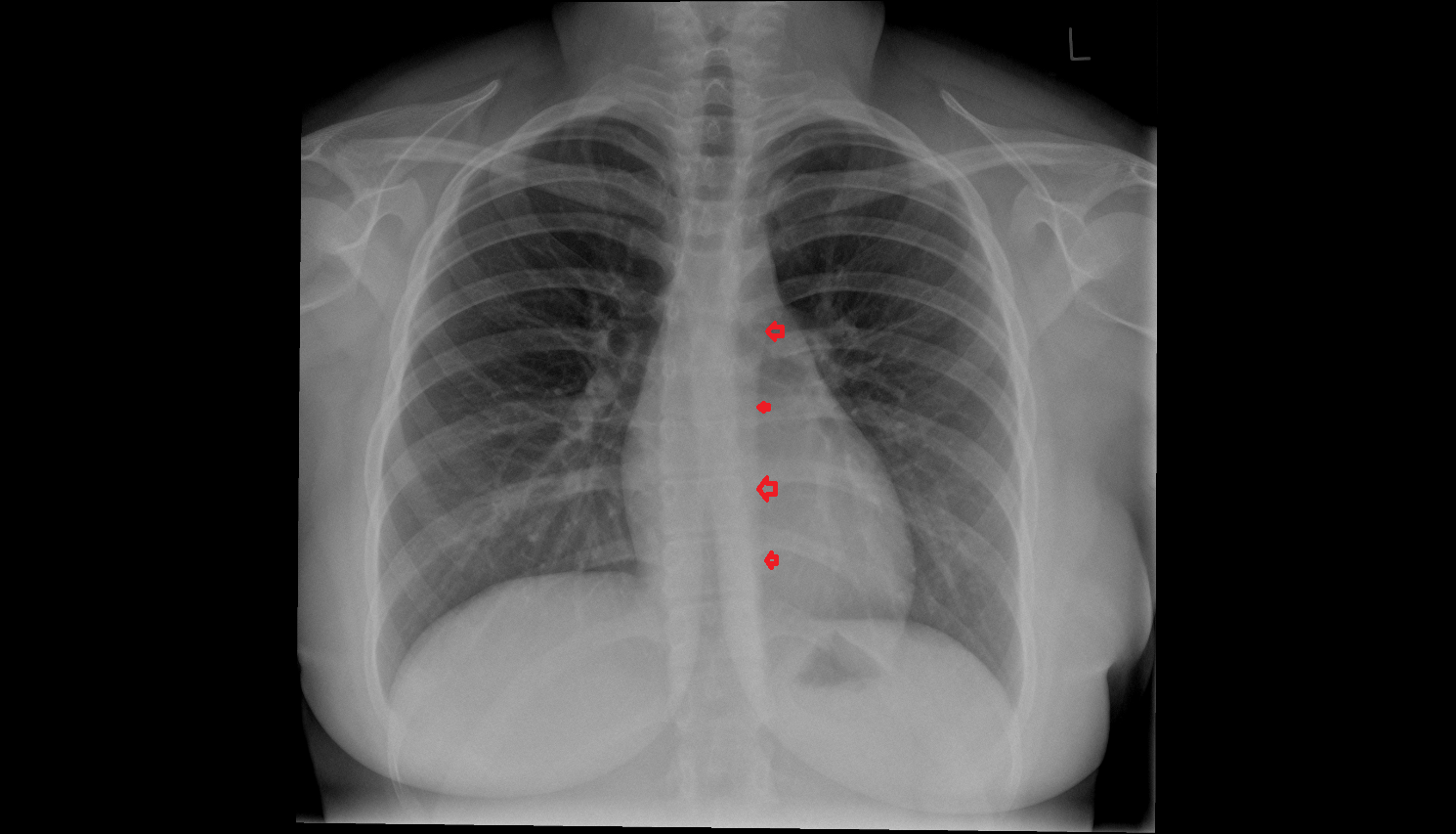 Descending thoracic aorta Anatomy, Location and Imaging Appearance CT anatomy image -img-00000-00000