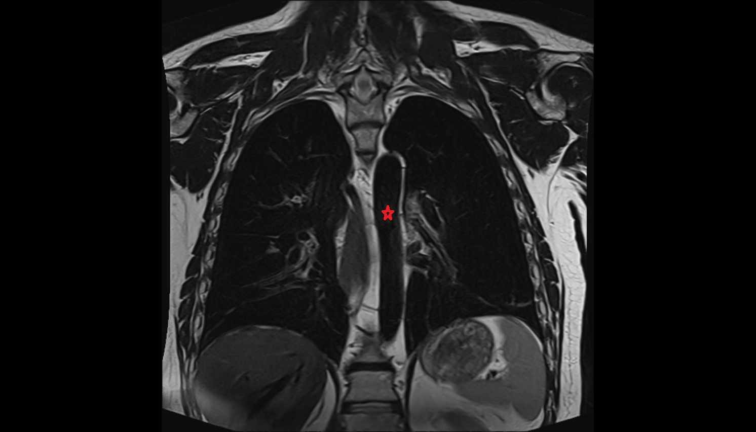 Descending thoracic aorta MRI coronal  image -img-00000-00000