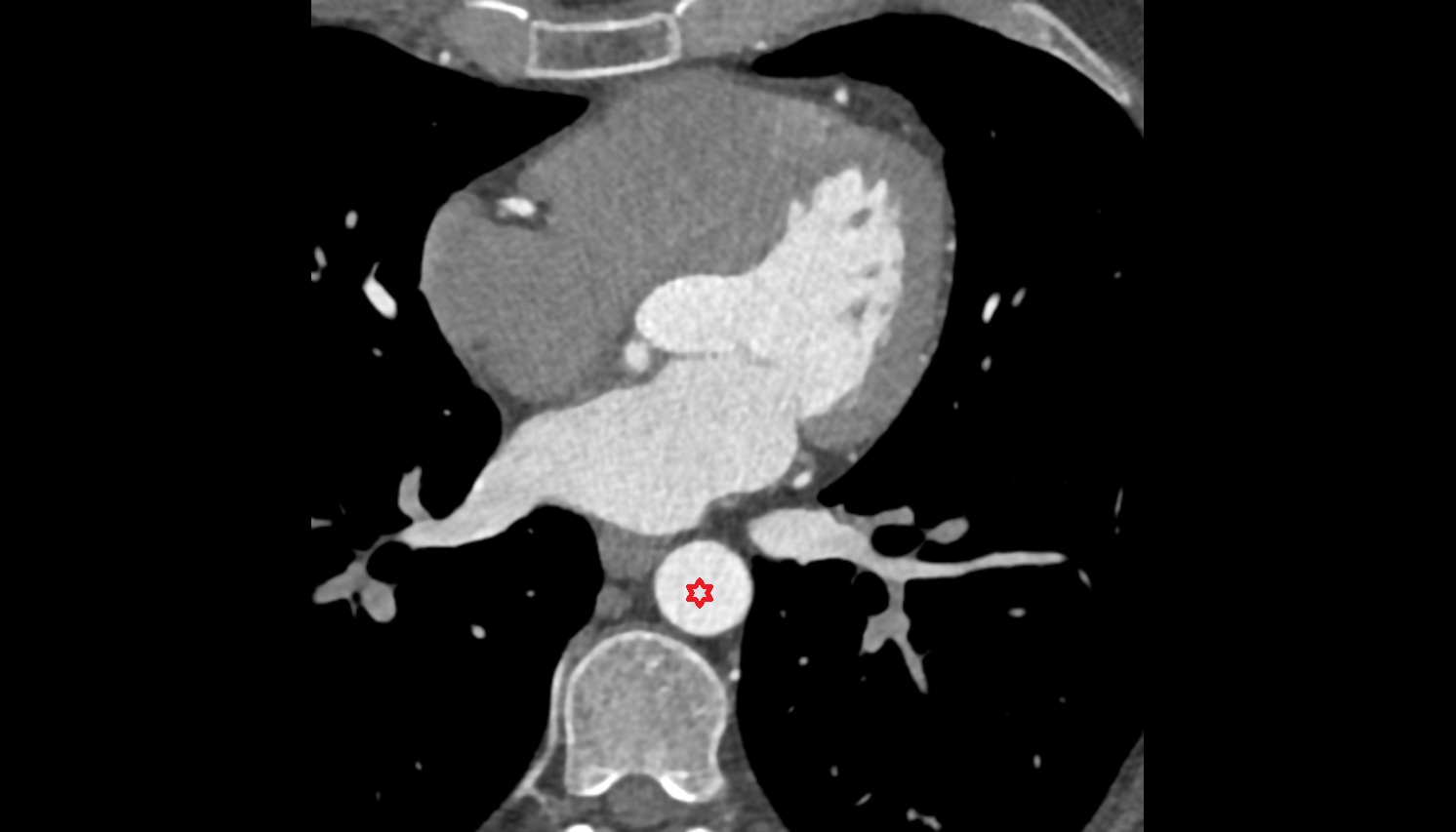 Descending thoracic aorta  anatomy ct axial  image -img-00000-00000