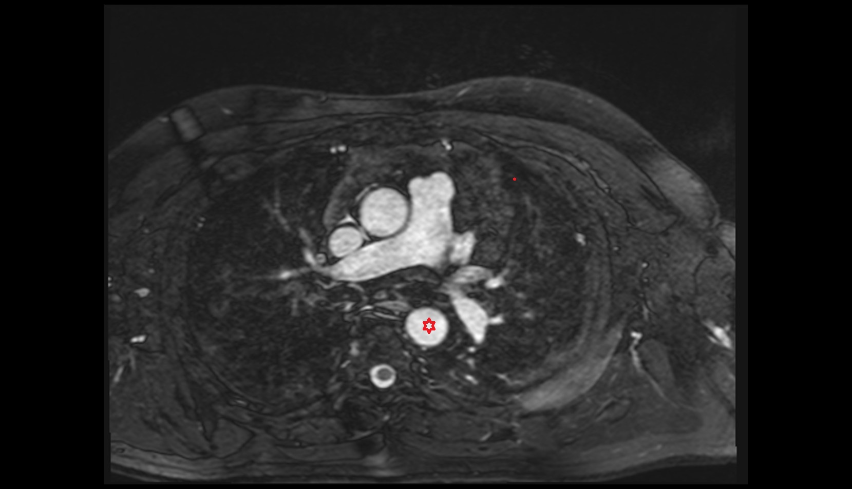 Descending thoracic aorta mri axial