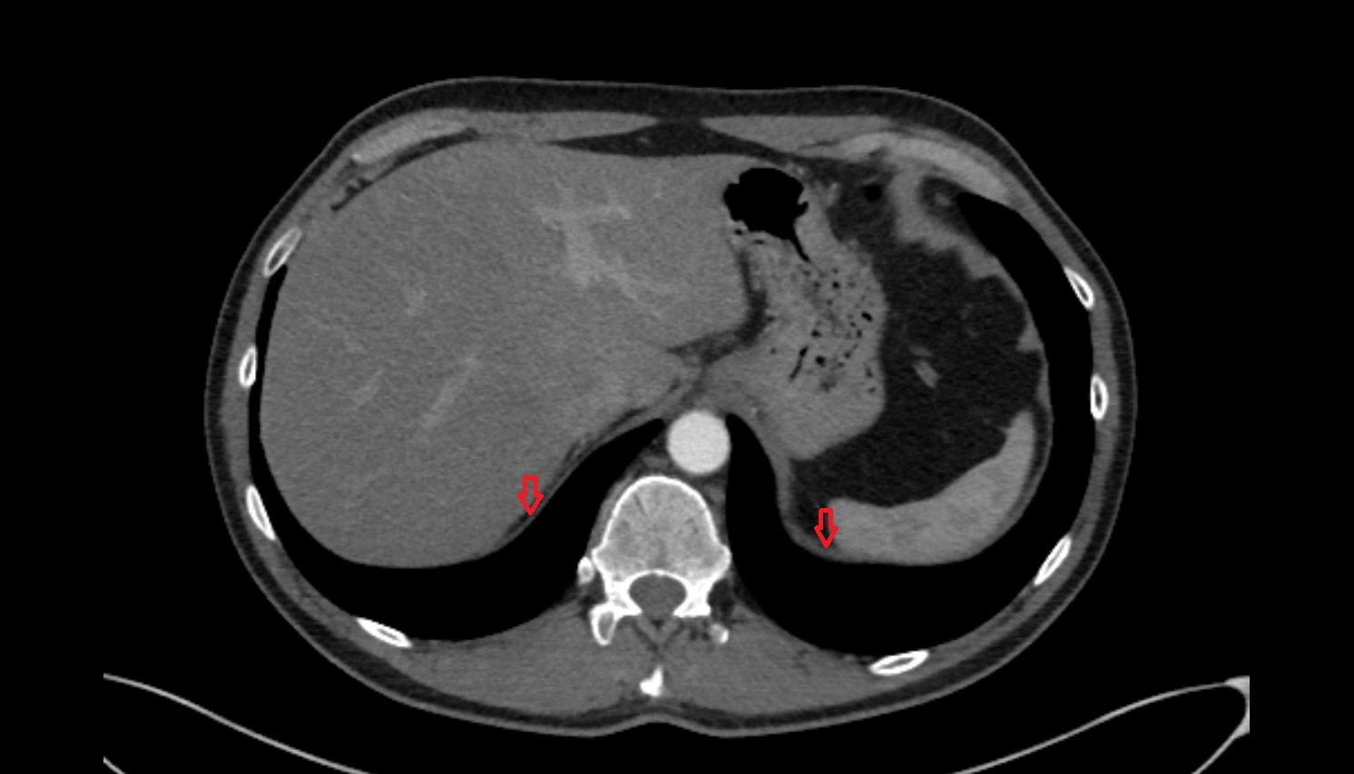 Diaphragm anatomy CT axial image -img-00000-00000