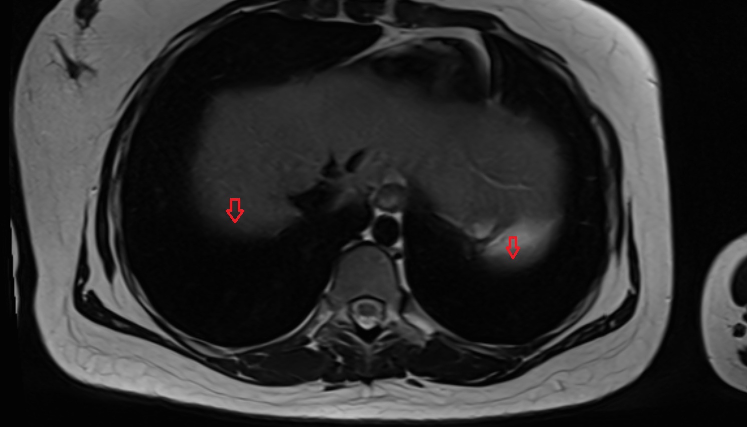 Diaphragm anatomy MRI AXIAL image -img-00000-00000