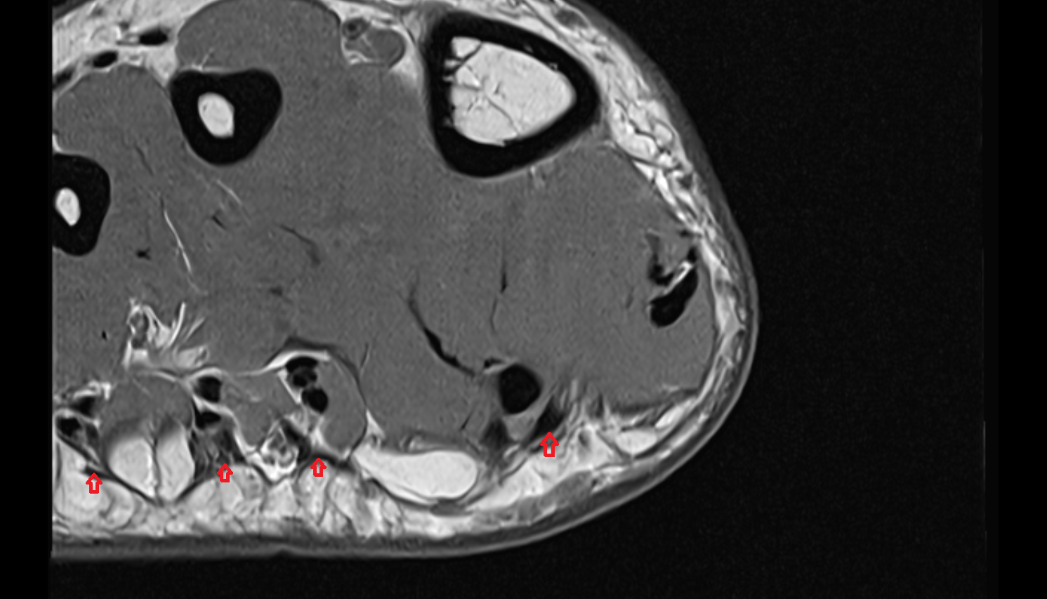 Digital slips of plantar aponeurosis  AXIAL cross sectional anatomy 3T MRI AI enhanced radiology image-img-00000-00000