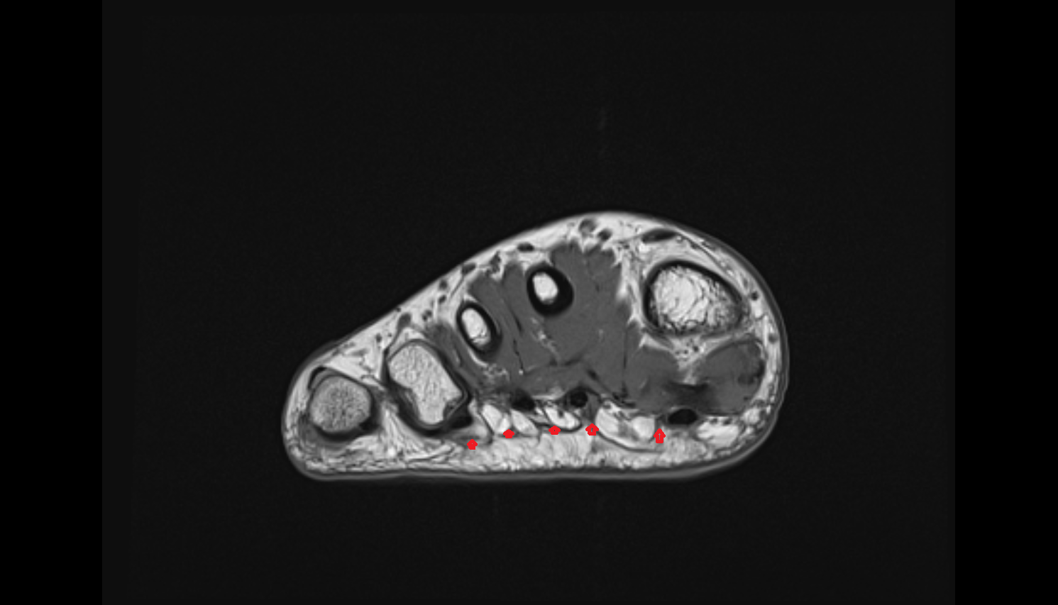 Digital slips of plantar aponeurosis  AXIAL cross sectional anatomy 3T MRI AI enhanced radiology image-img-00000-00000_00001
