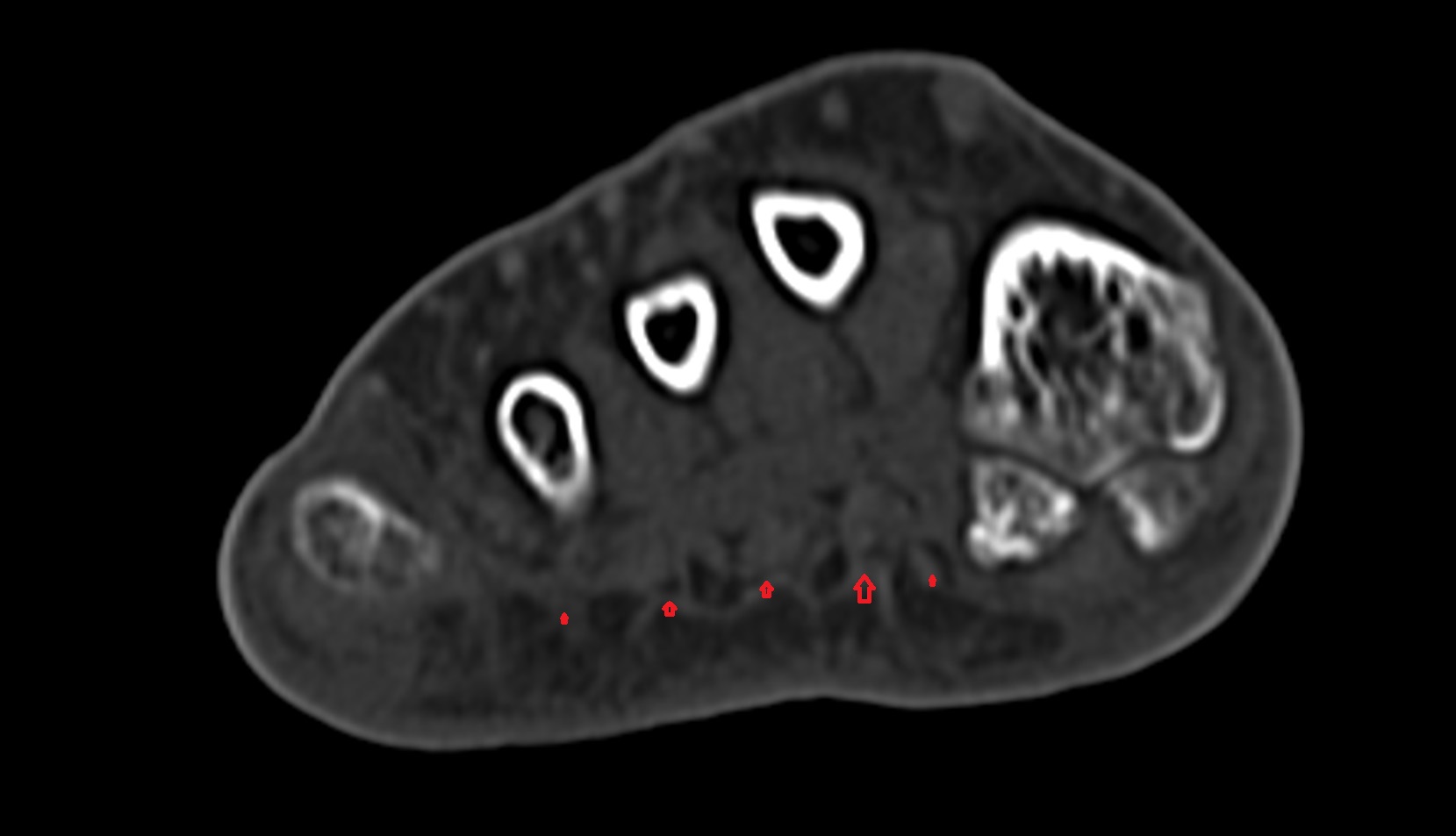 Digital slips of plantar aponeurosis CT axial image