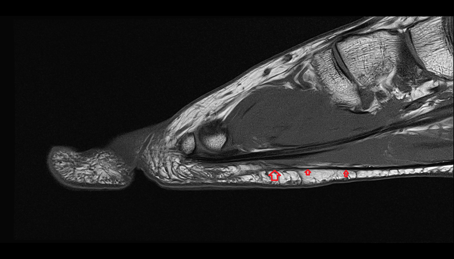 Digital slips of plantar aponeurosis  SAG cross sectional anatomy 3T MRI AI enhanced radiology image-img-00000-00000