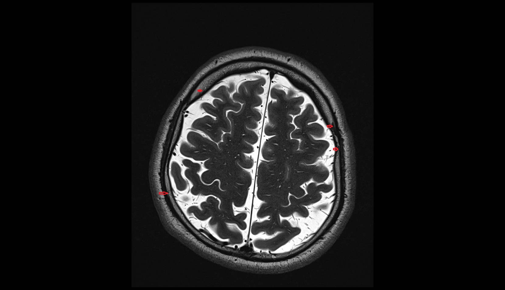 Diploic veins MRI 3T axial image