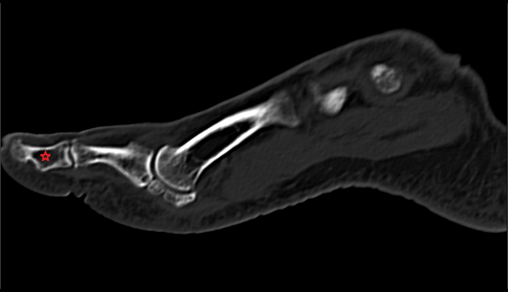 Distal Phalanx of the Great Toe ct sag image