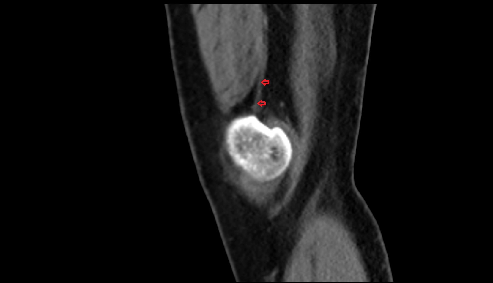Distal adductor magnus tendon sagittal image