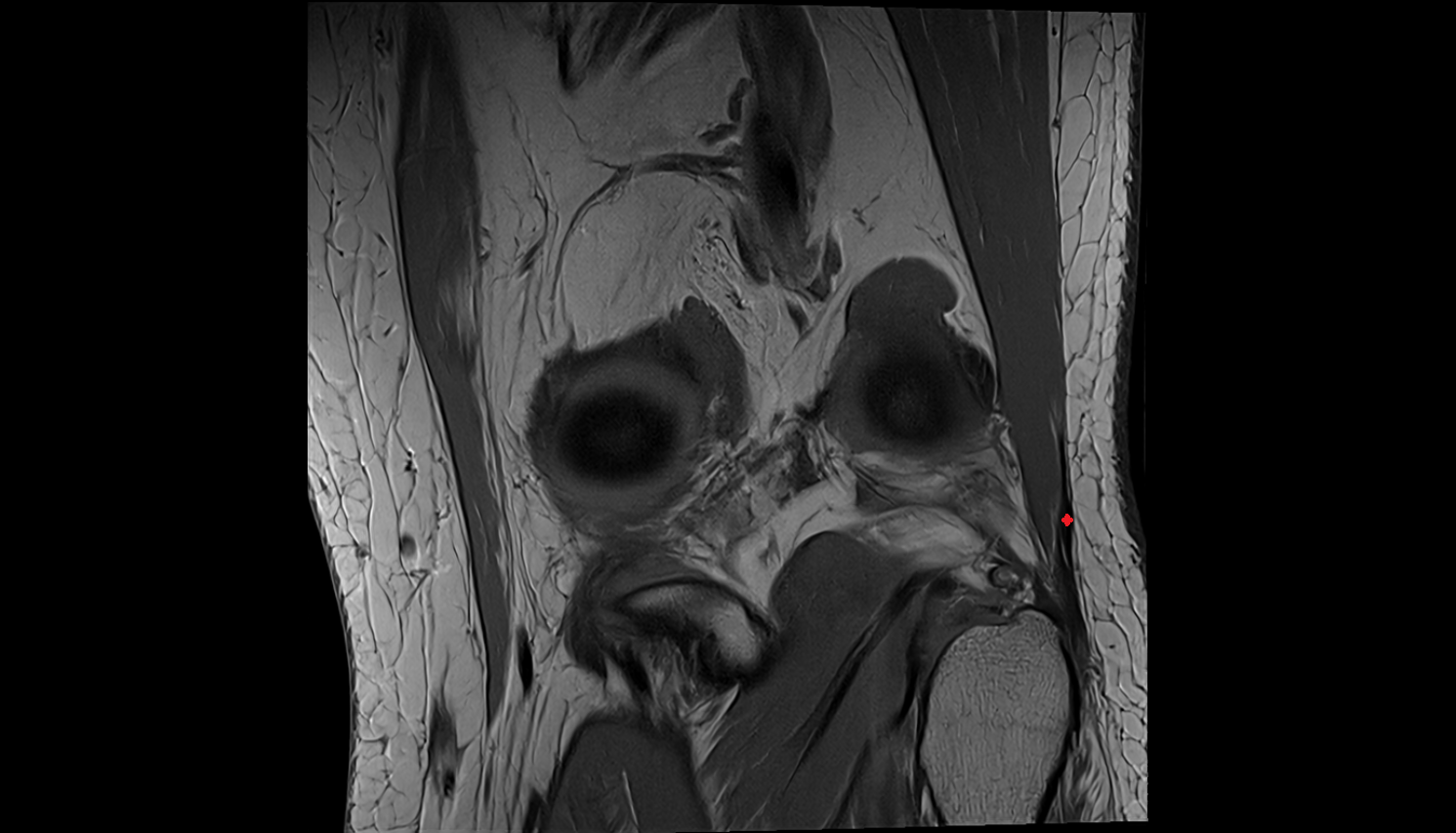 Distal biceps femoris tendon coronal  cross sectional anatomy 3T MRI AI enhanced  radiology  anatomy image-img-00000-00000