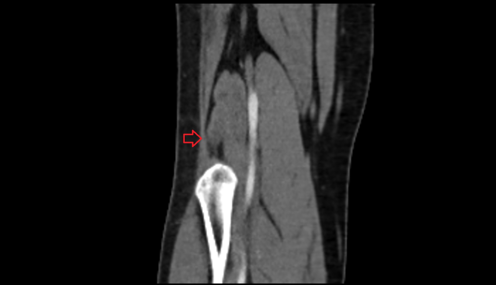 Distal biceps femoris tendon coronal ct image