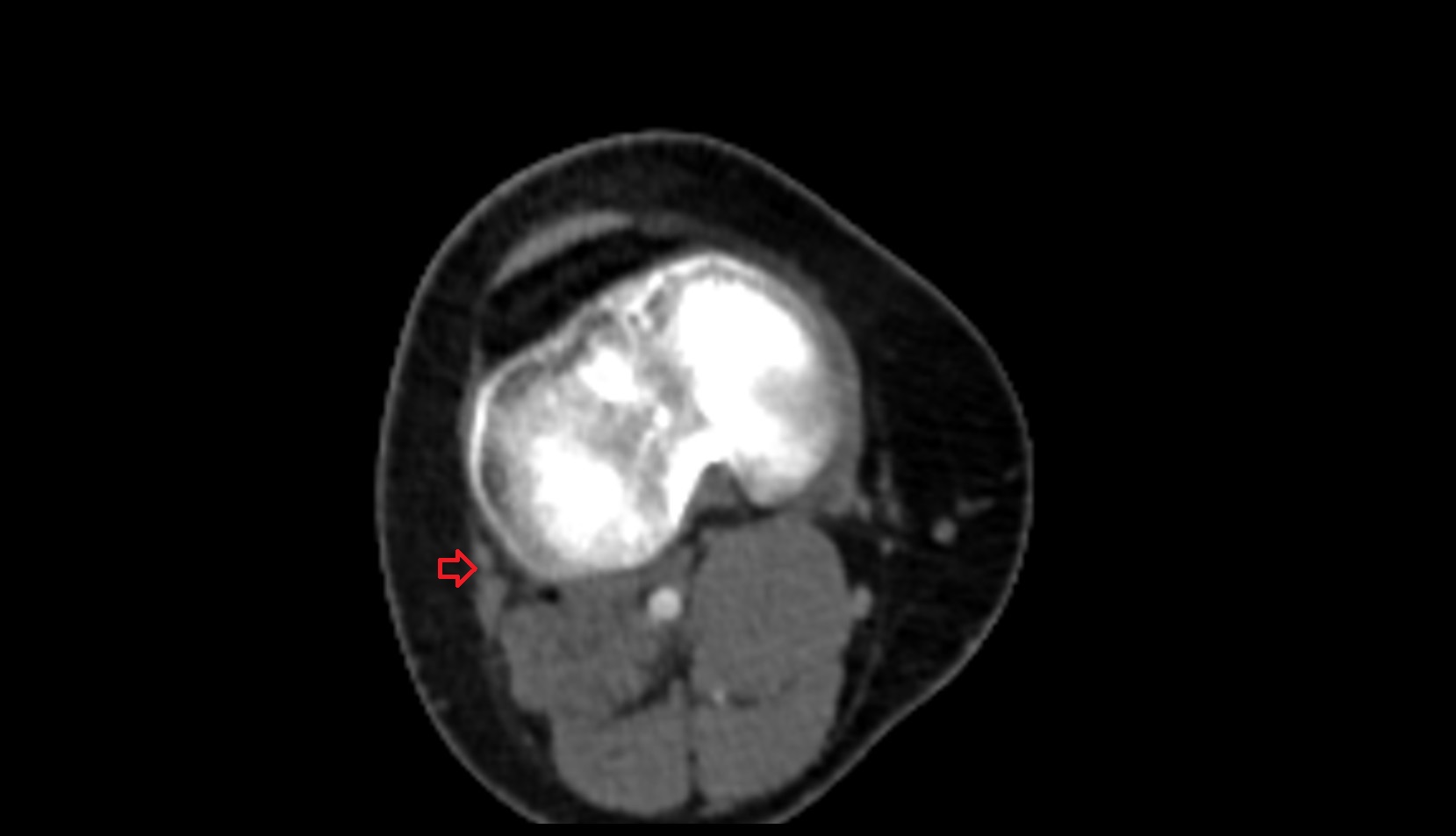 Distal biceps femoris tendon ct axial image
