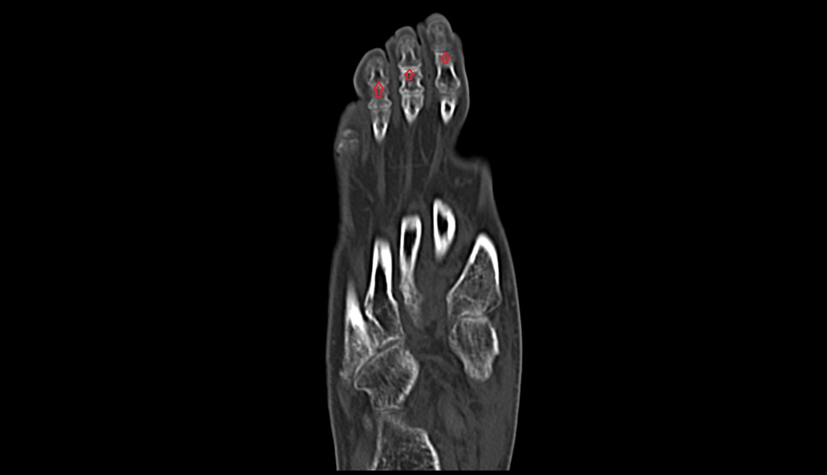Distal interphalangeal joint of foot CT axial