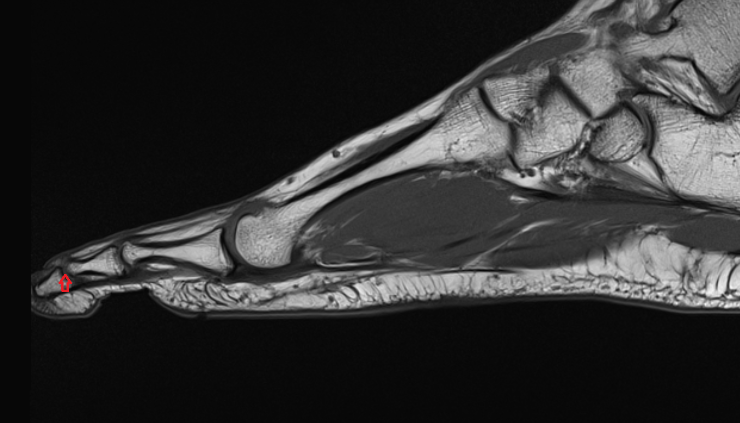 Distal interphalangeal joint of foot SAG cross sectional anatomy 3T MRI AI enhanced radiology image-img-00000-00000