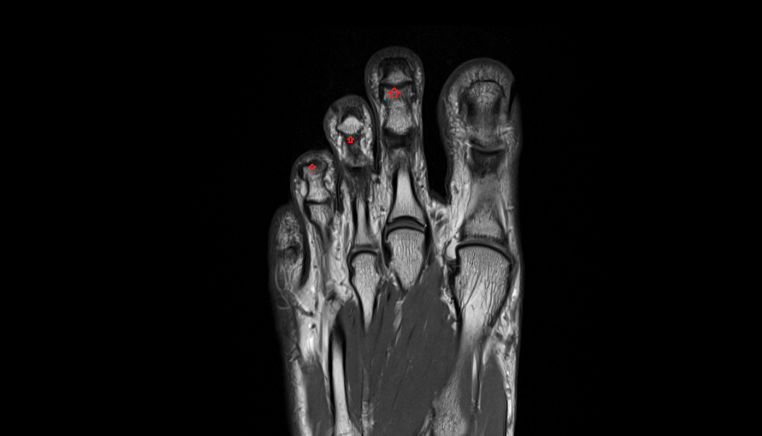 Distal interphalangeal joint of foot coronal cross sectional anatomy 3T MRI AI enhanced radiology image-img-00000-00000