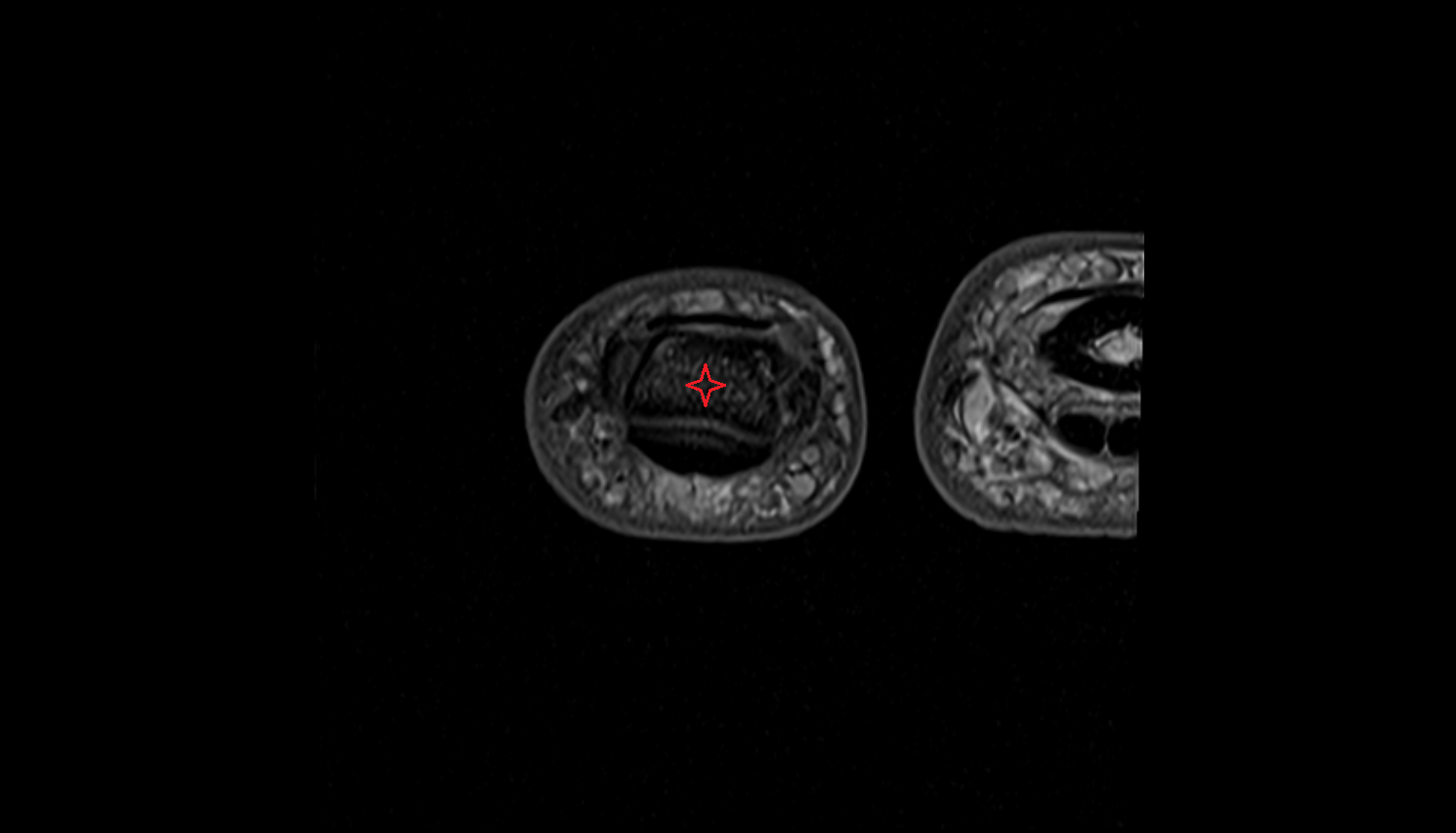 Distal interphalangeal joint of hand  axial cross sectional anatomy 3T MRI AI enhanced radiology image-img-00000-00000_00001