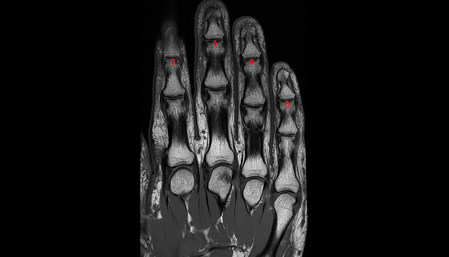 Distal interphalangeal joint of hand  coronal cross sectional anatomy 3T MRI AI enhanced radiology image-img-00000-00000