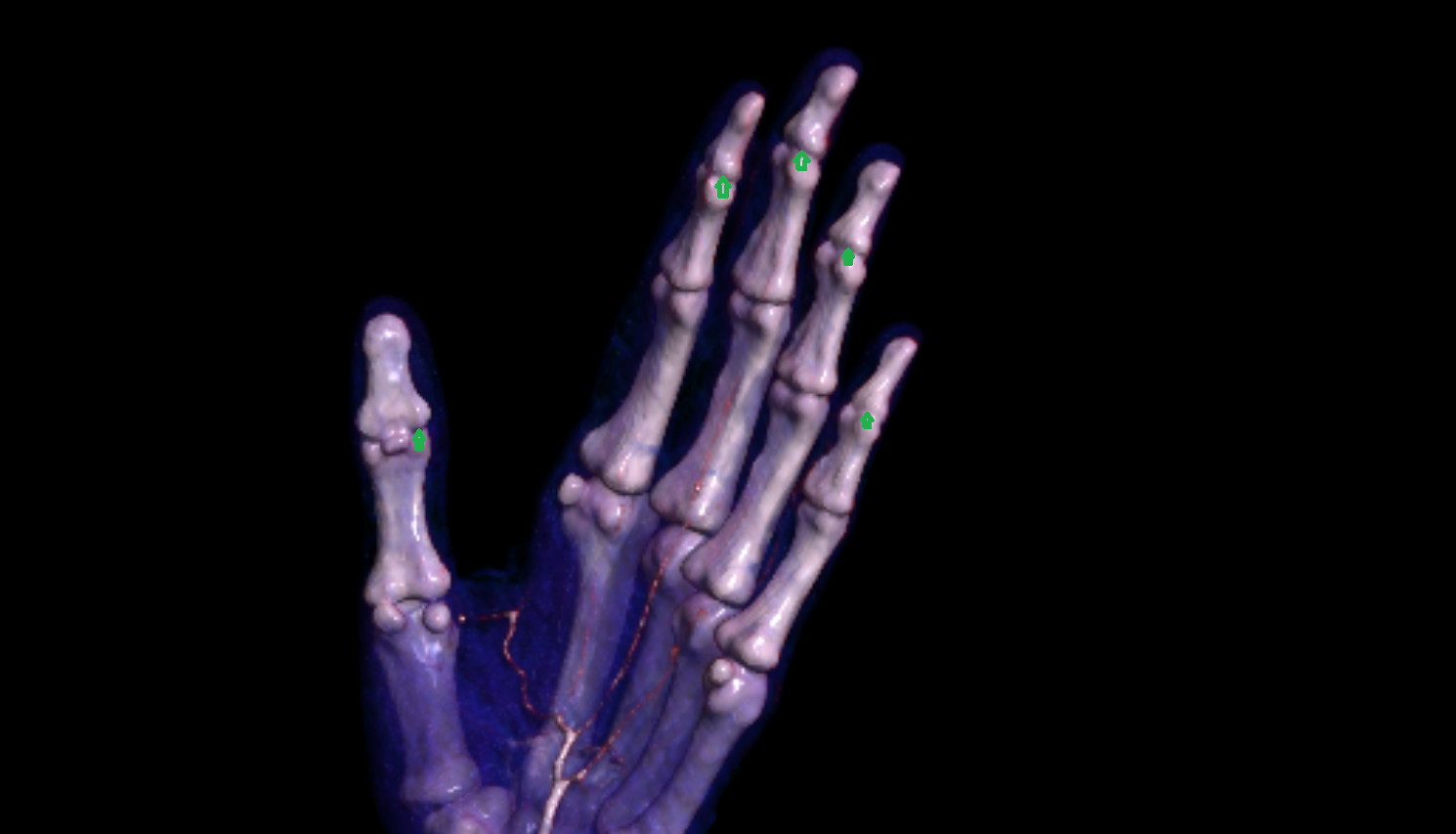 Distal interphalangeal joint of hand of hand 3D VRT  CT image -img-00000-00000