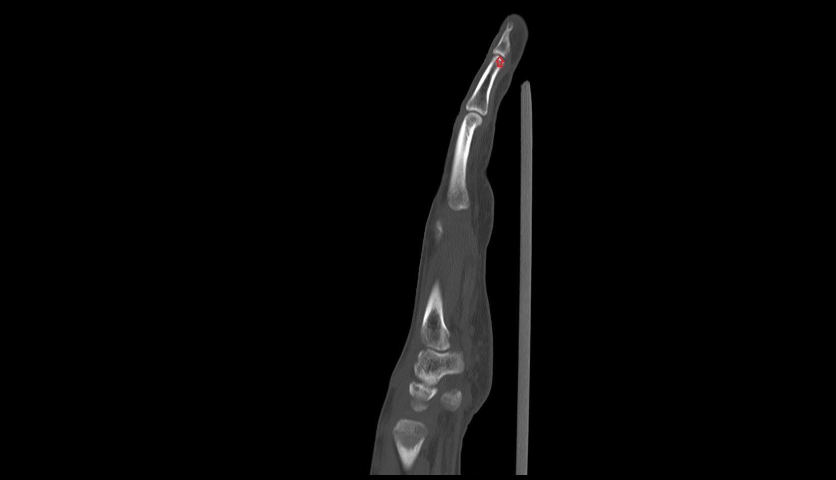 Distal interphalangeal joint of hand sag ct image