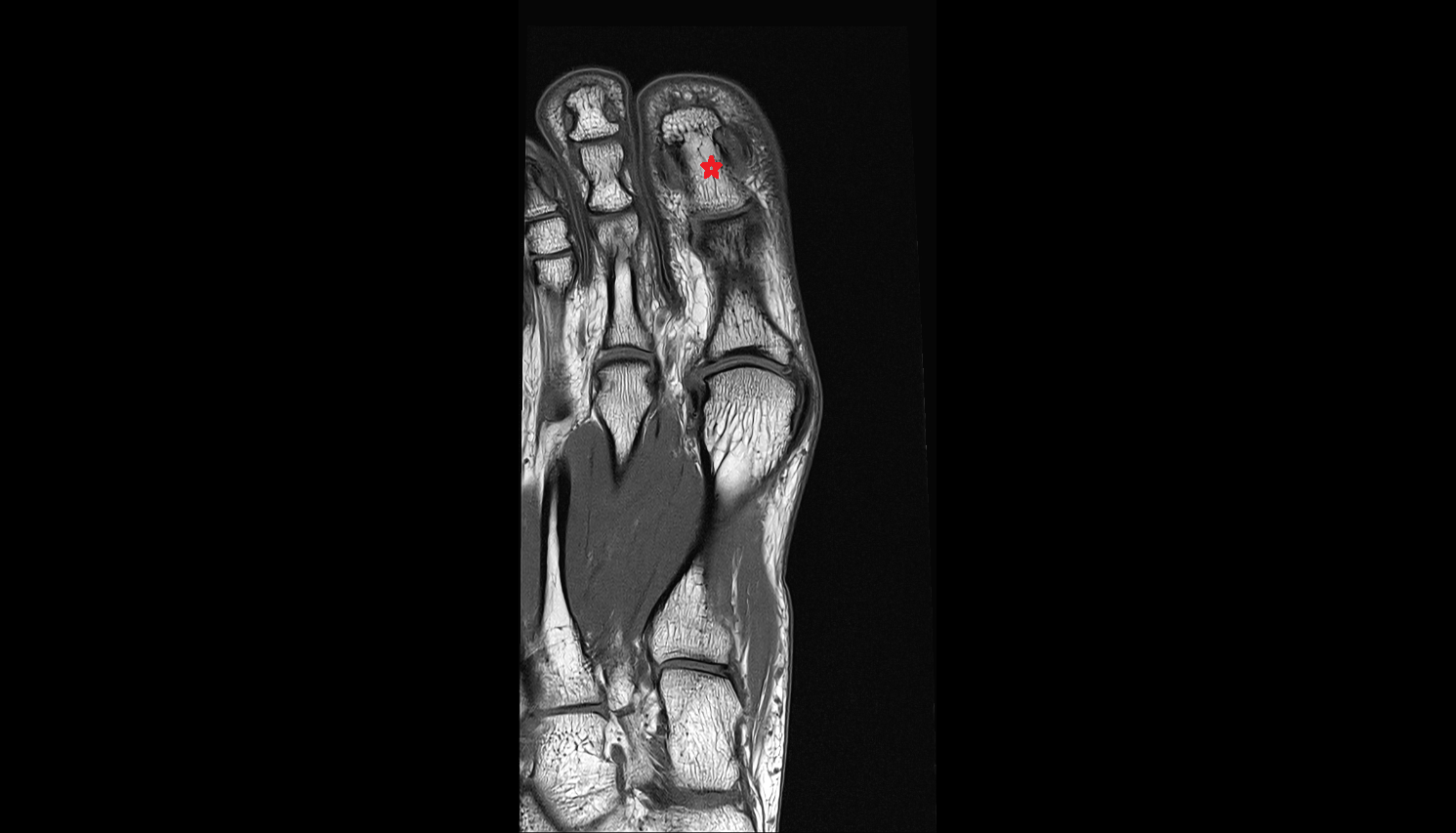 Distal phalanx of great toe foot coronal cross sectional anatomy 3T MRI AI enhanced radiology image-img-00000-00000