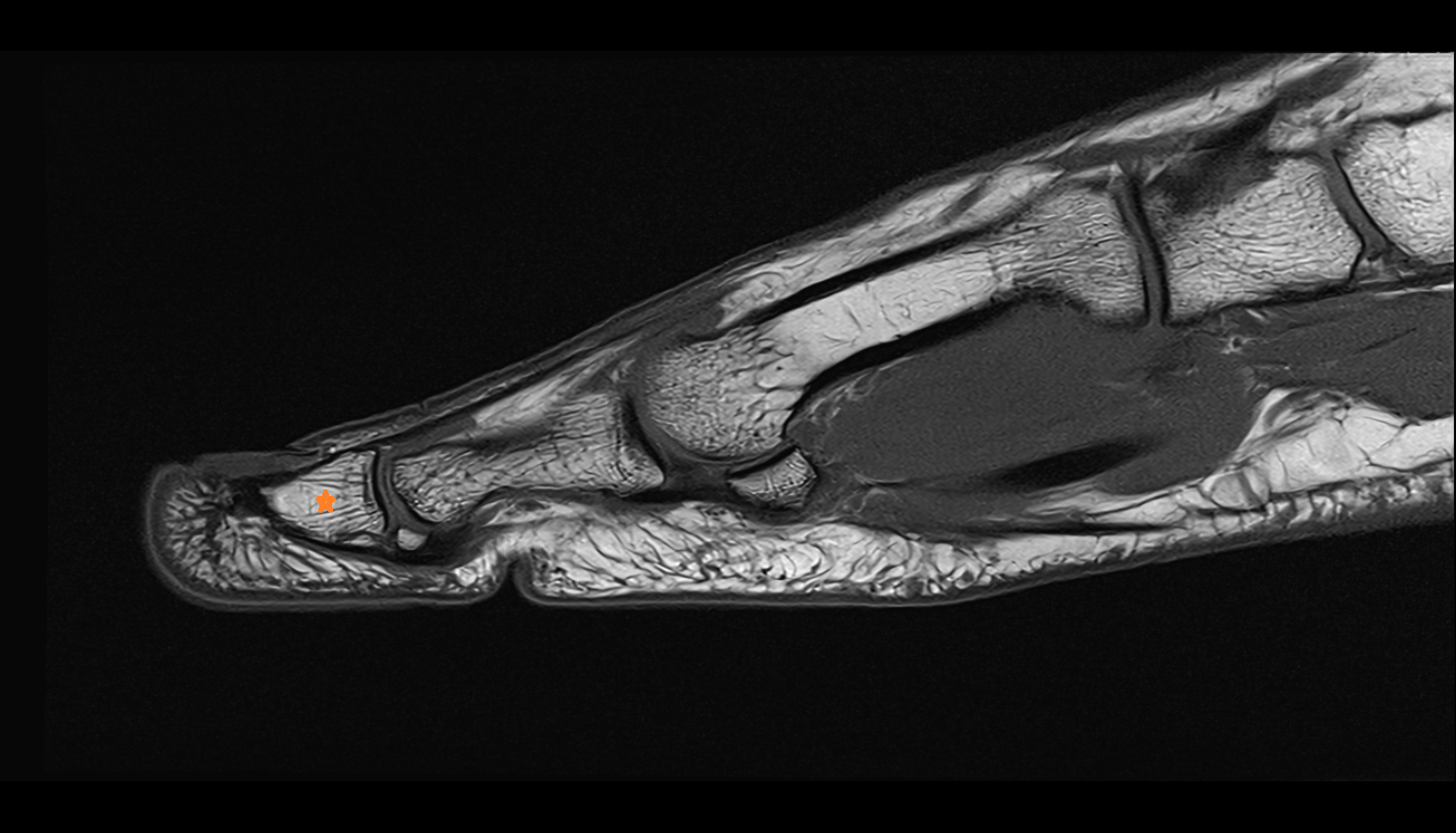 Distal phalanx of great toe foot sagittal cross sectional anatomy 3T MRI AI enhanced radiology image-img-00000-00000
