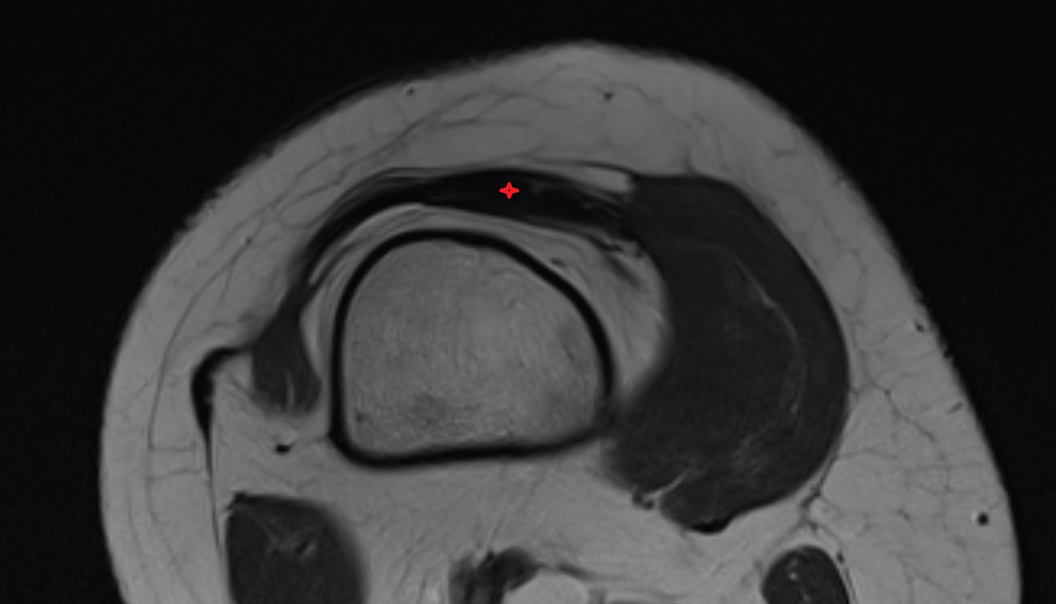 Distal quadriceps femoris tendon  axial  cross sectional anatomy 3T MRI AI enhanced  radiology  anatomy image-img-00000-00000