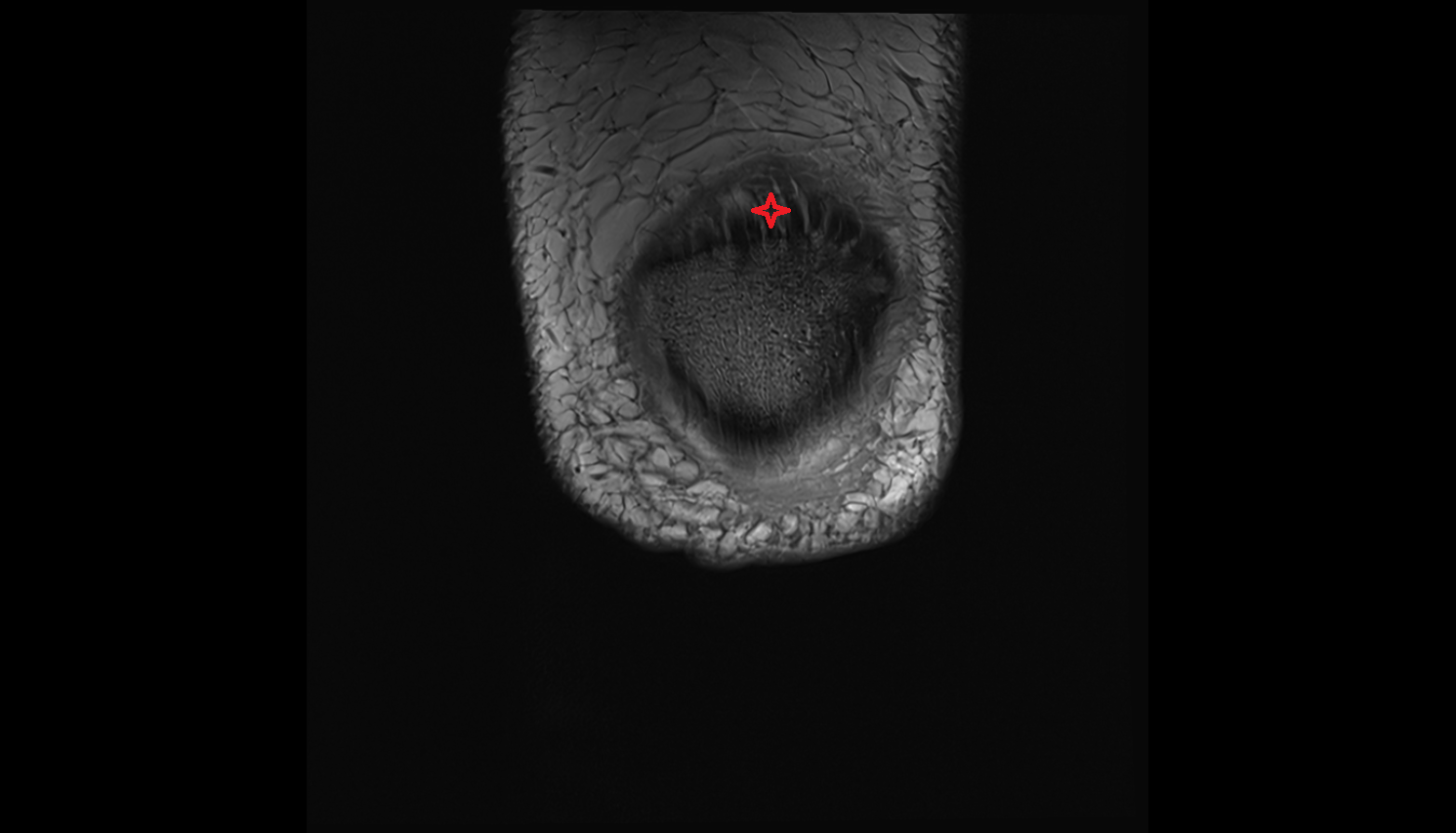 Distal quadriceps femoris tendon coronal  cross sectional anatomy 3T MRI AI enhanced  radiology  anatomy image-img-00000-00000