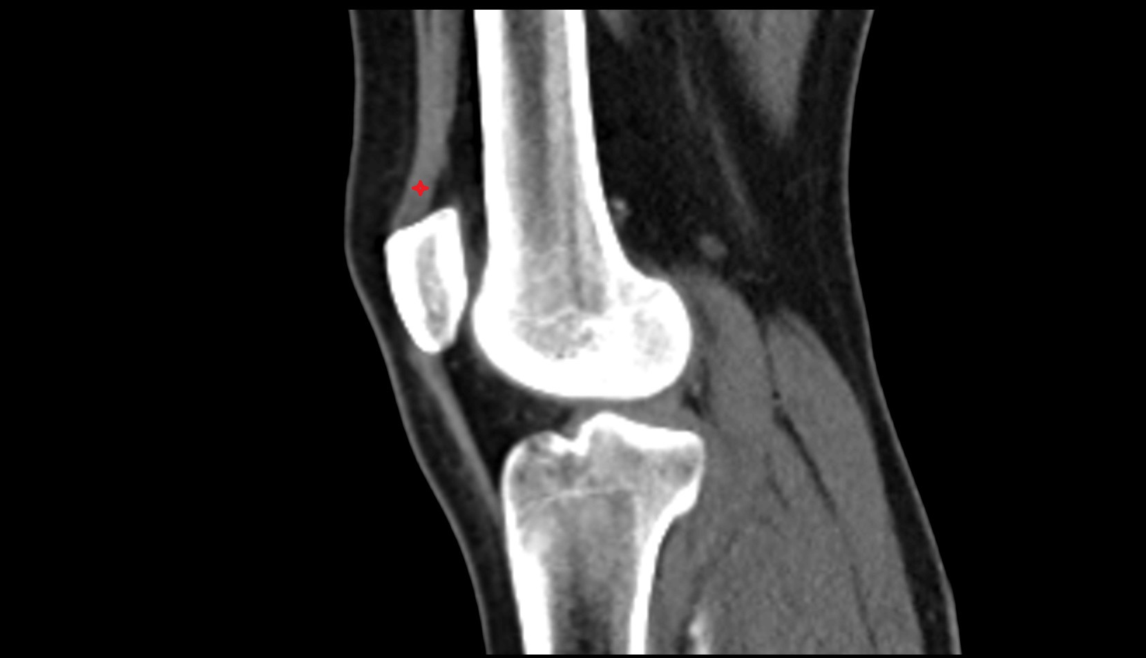Distal quadriceps femoris tendon ct sagittal image