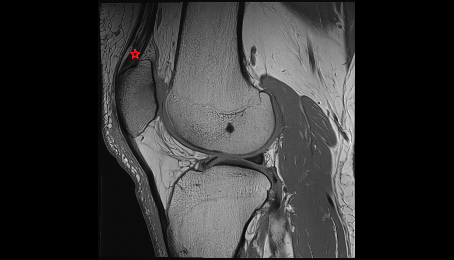 Distal quadriceps femoris tendon sagittal  cross sectional anatomy 3T MRI AI enhanced  radiology  anatomy image-img-00000-00000