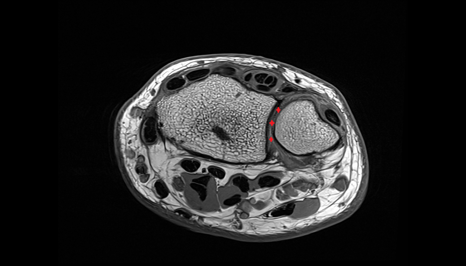 Distal radioulnar joint  axial cross sectional anatomy 3T MRI AI enhanced radiology image-img-00000-00000