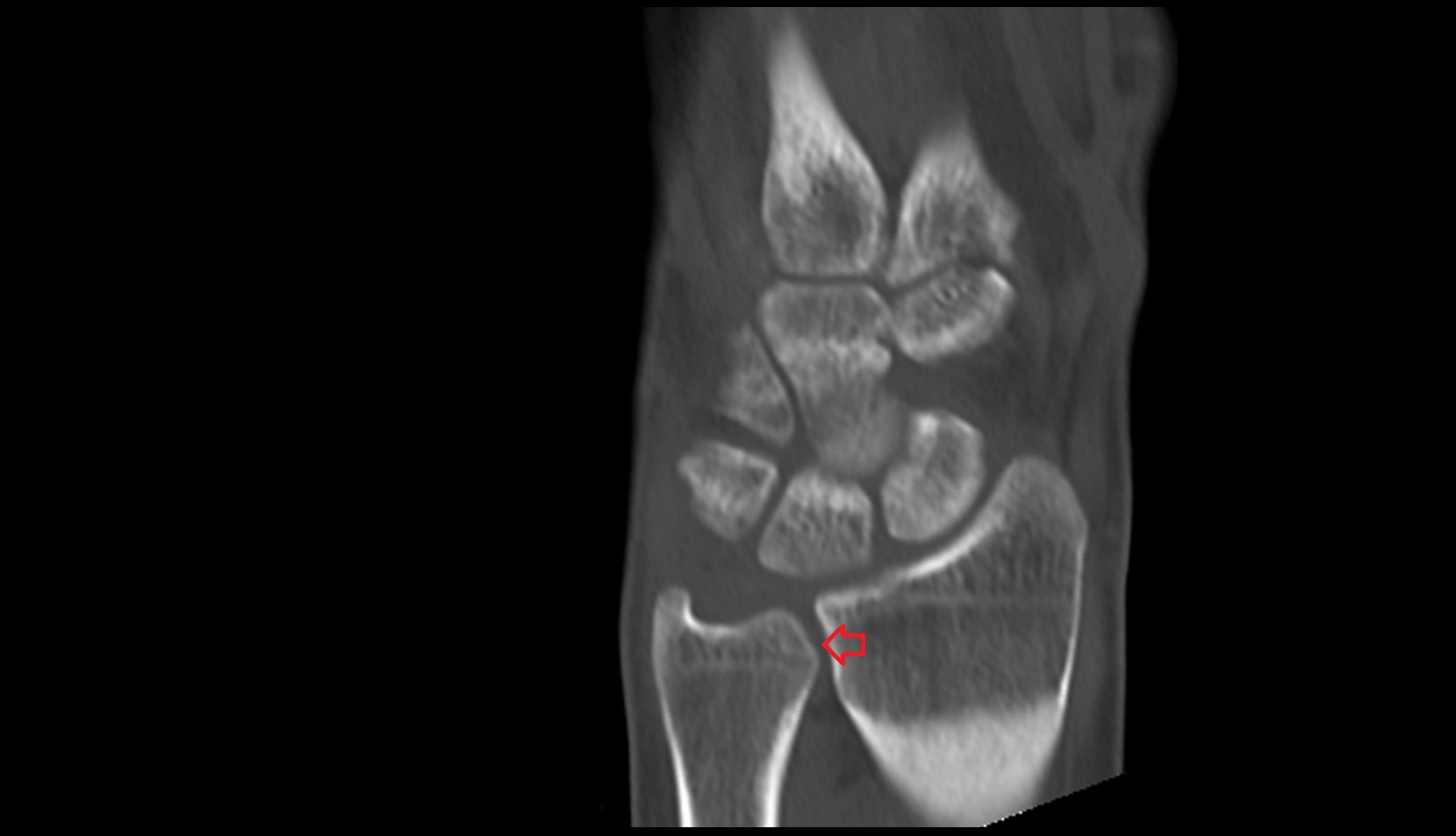 Distal radioulnar joint ct image