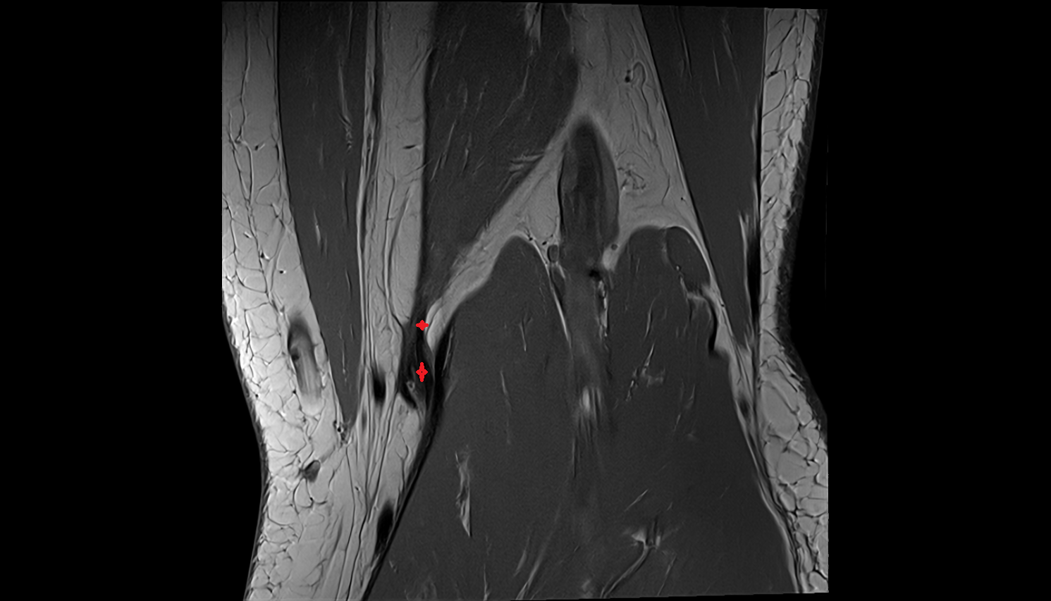 Distal semimembranosus tendon coronal  cross sectional anatomy 3T MRI AI enhanced  radiology  anatomy image-img-00000-00000
