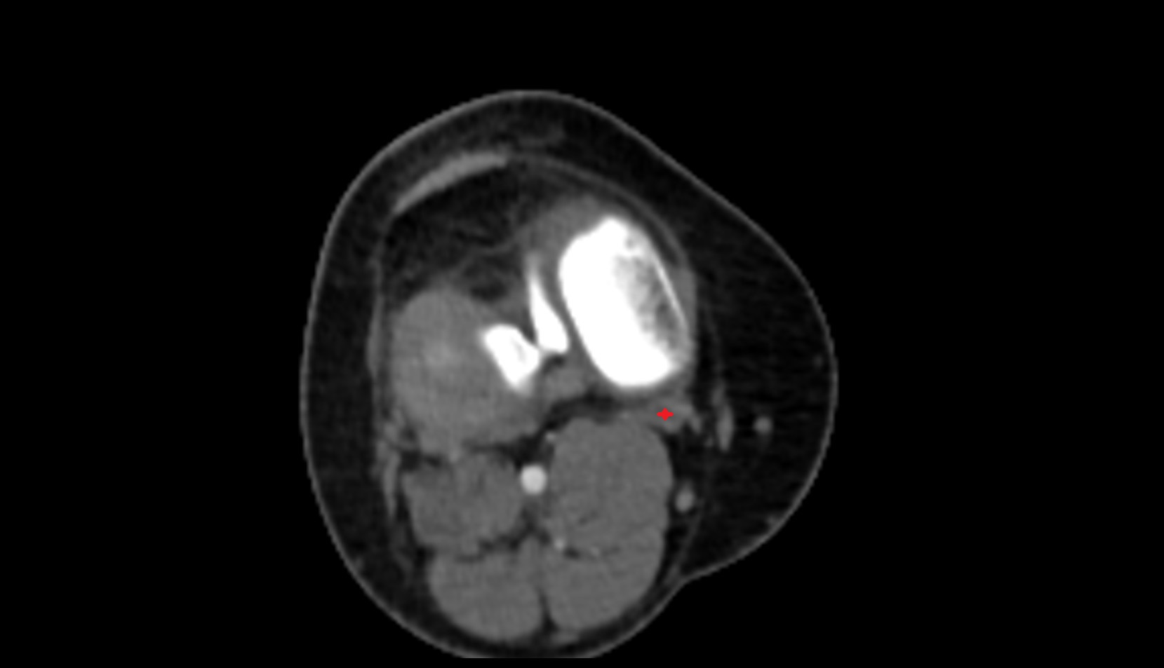 Distal semimembranosus tendon ct axial image