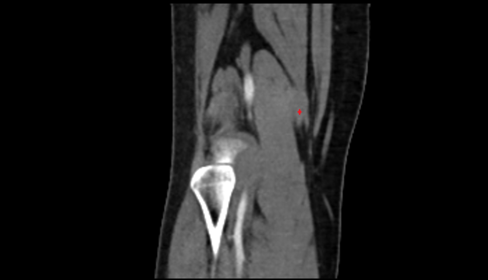 Distal semimembranosus tendon ct coronal image