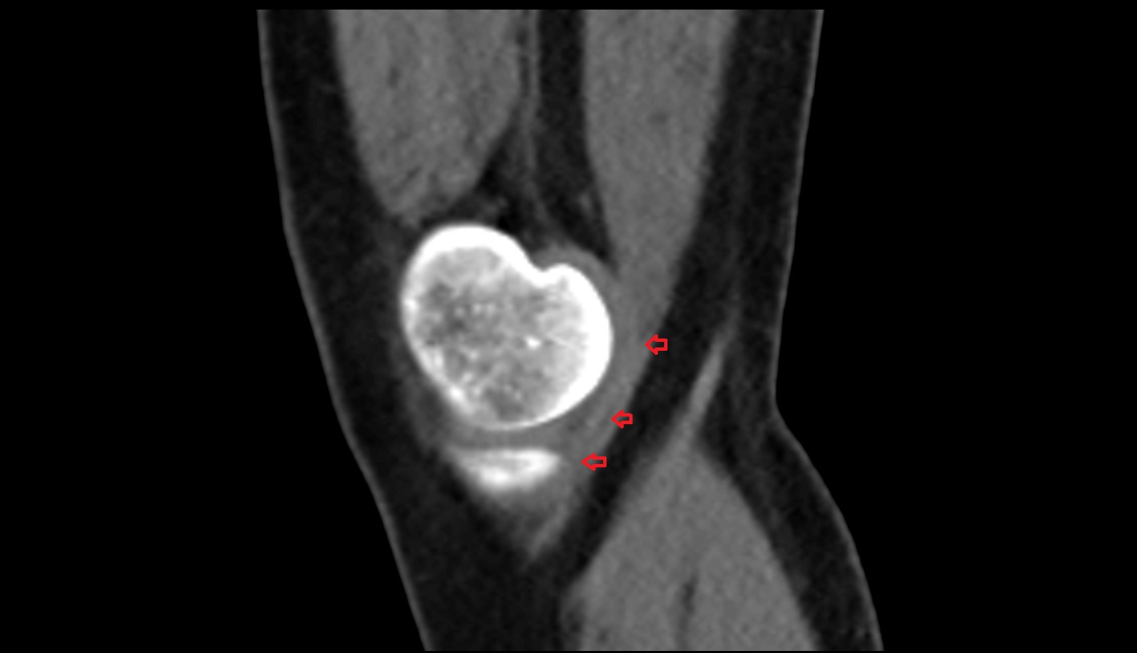 Distal semimembranosus tendon ct sagittal image