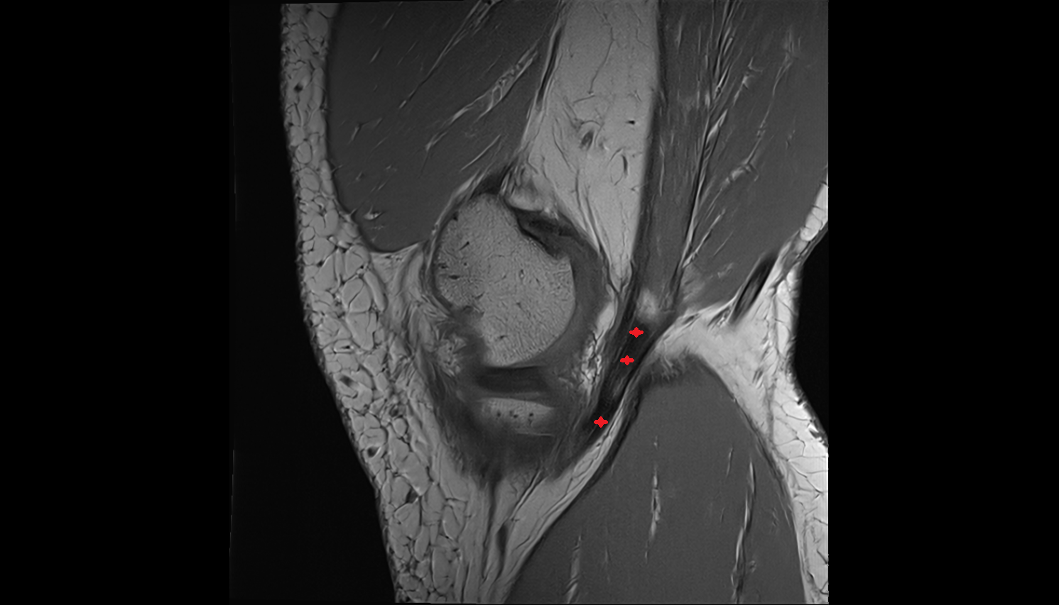 Distal semimembranosus tendon sag  cross sectional anatomy 3T MRI AI enhanced  radiology  anatomy image-img-00000-00000