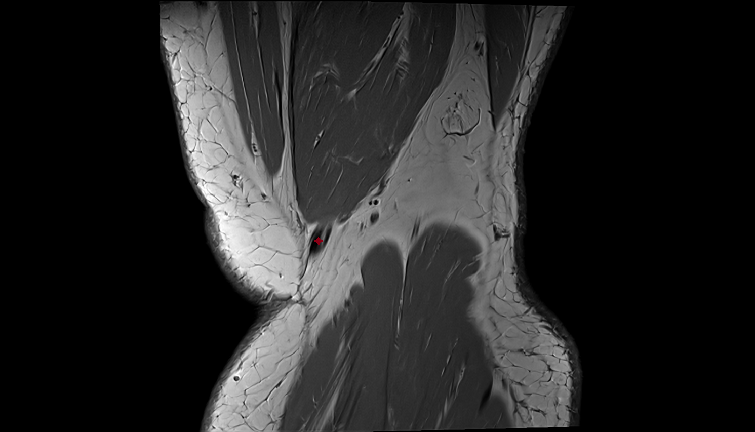 Distal semitendinosus tendon coronal  cross sectional anatomy 3T MRI AI enhanced  radiology  anatomy image-img-00000-00000