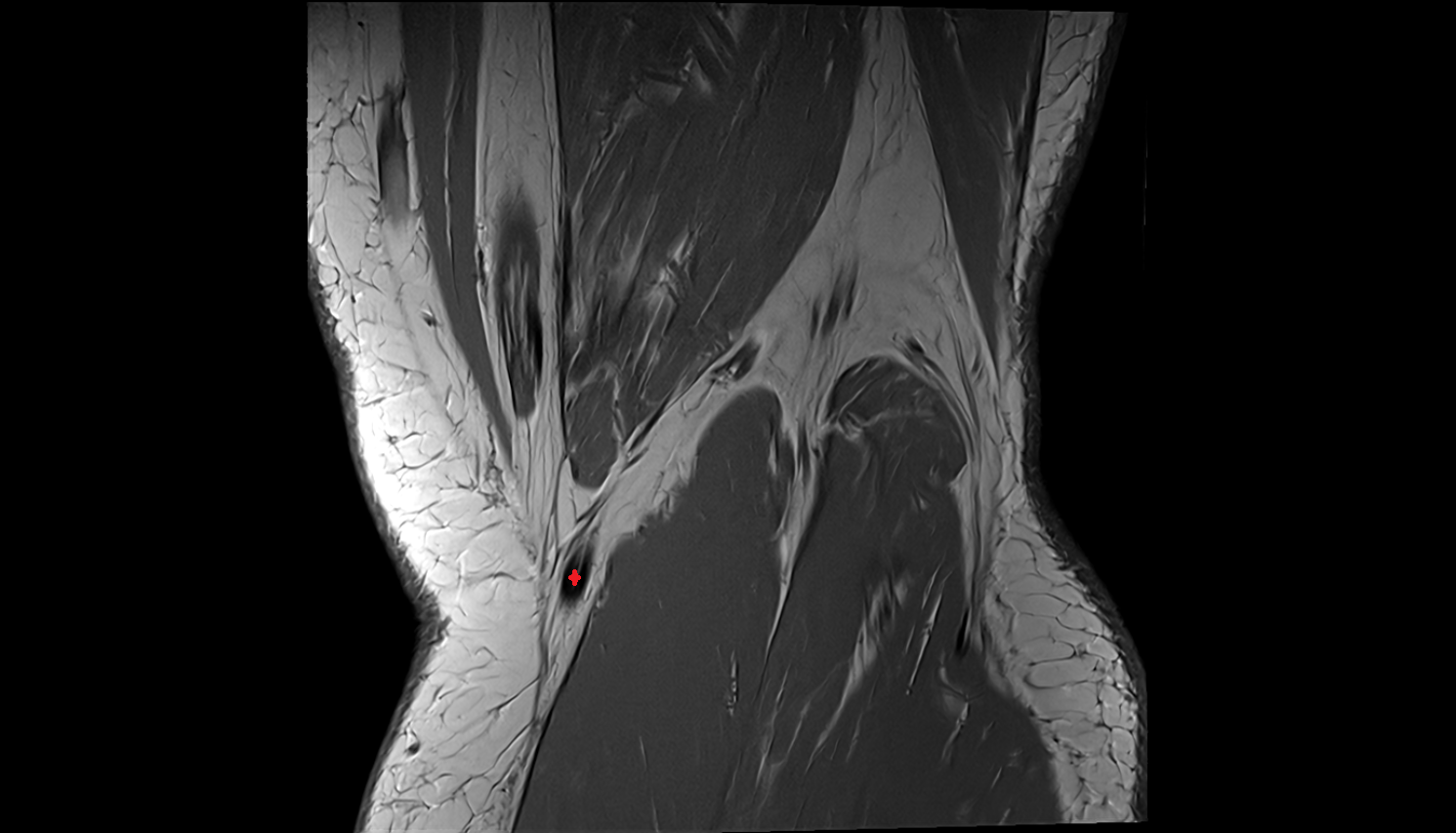 Distal semitendinosus tendon coronal  cross sectional anatomy 3T MRI AI enhanced  radiology  anatomy image-img-00000-00000_00001