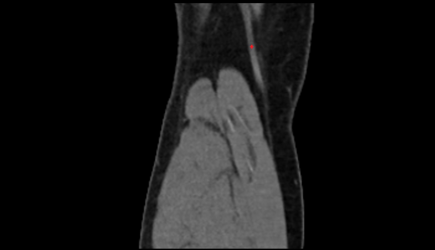 Distal semitendinosus tendon ct coronal image