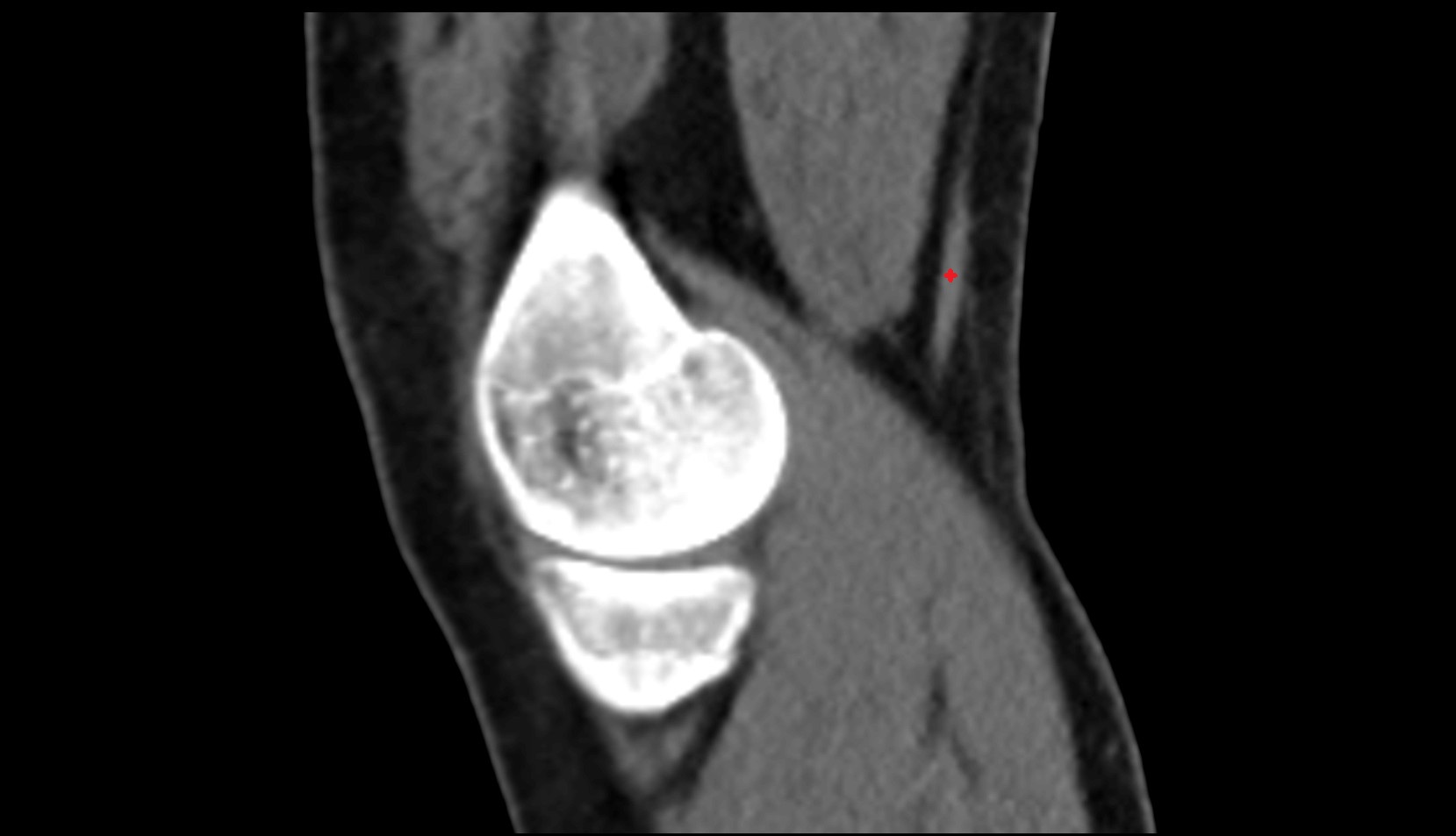 Distal semitendinosus tendon ct sagittal image