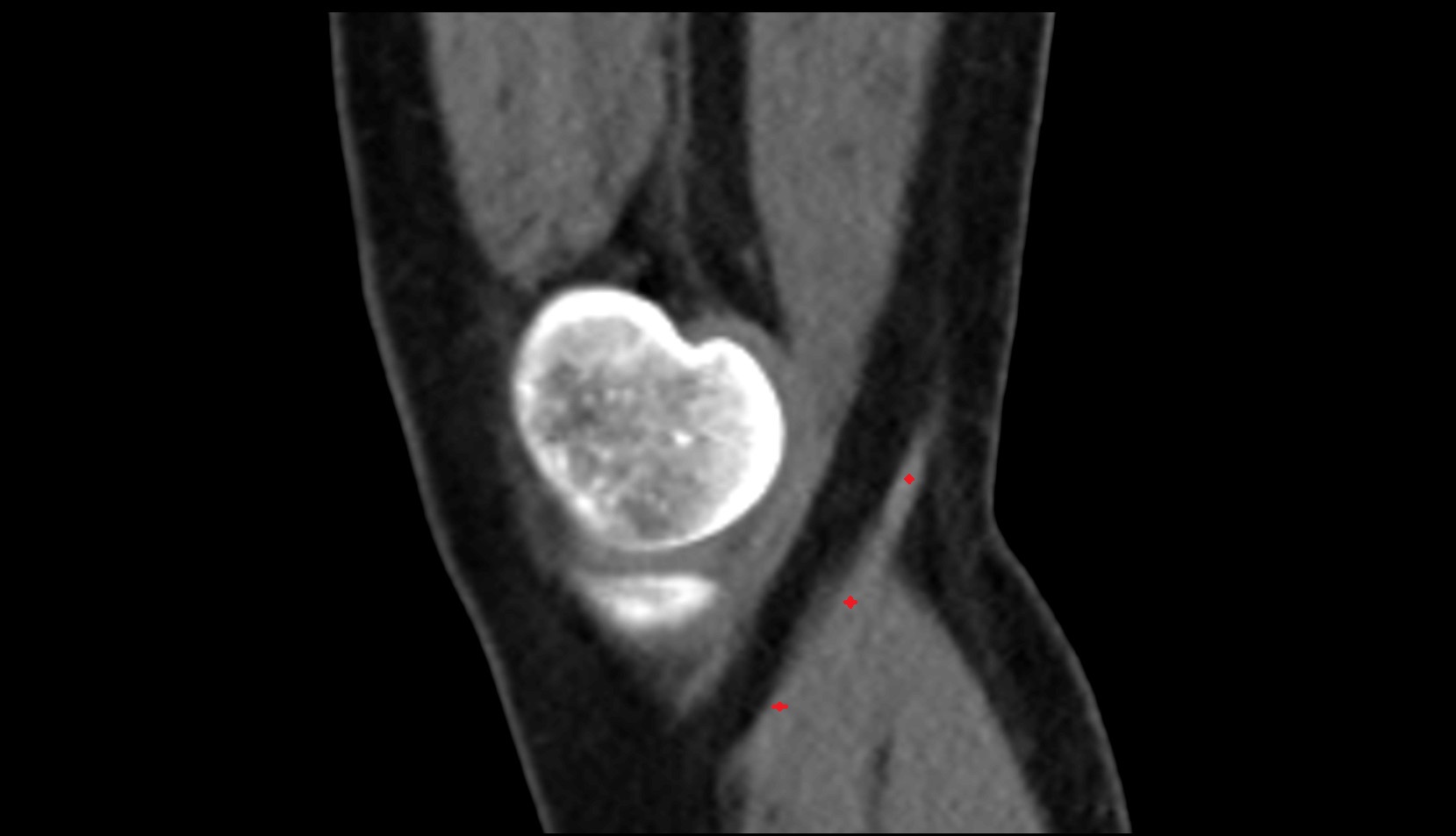 Distal semitendinosus tendon ct sagittal image 1