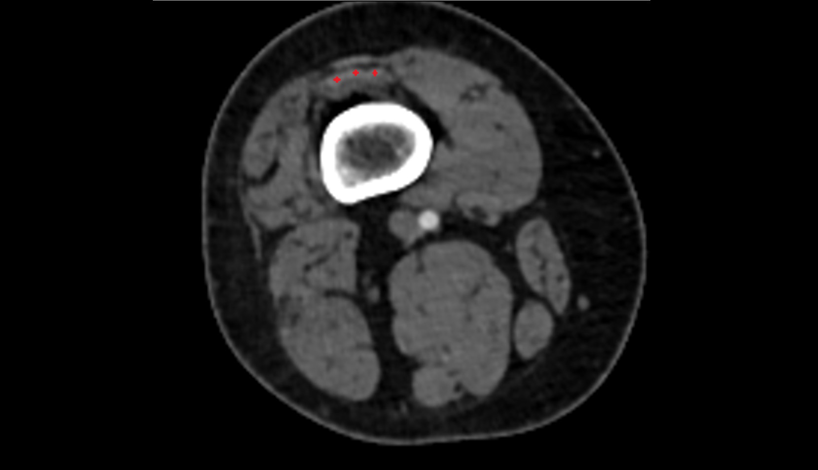 Distal vastus intermedius tendon axial ct image
