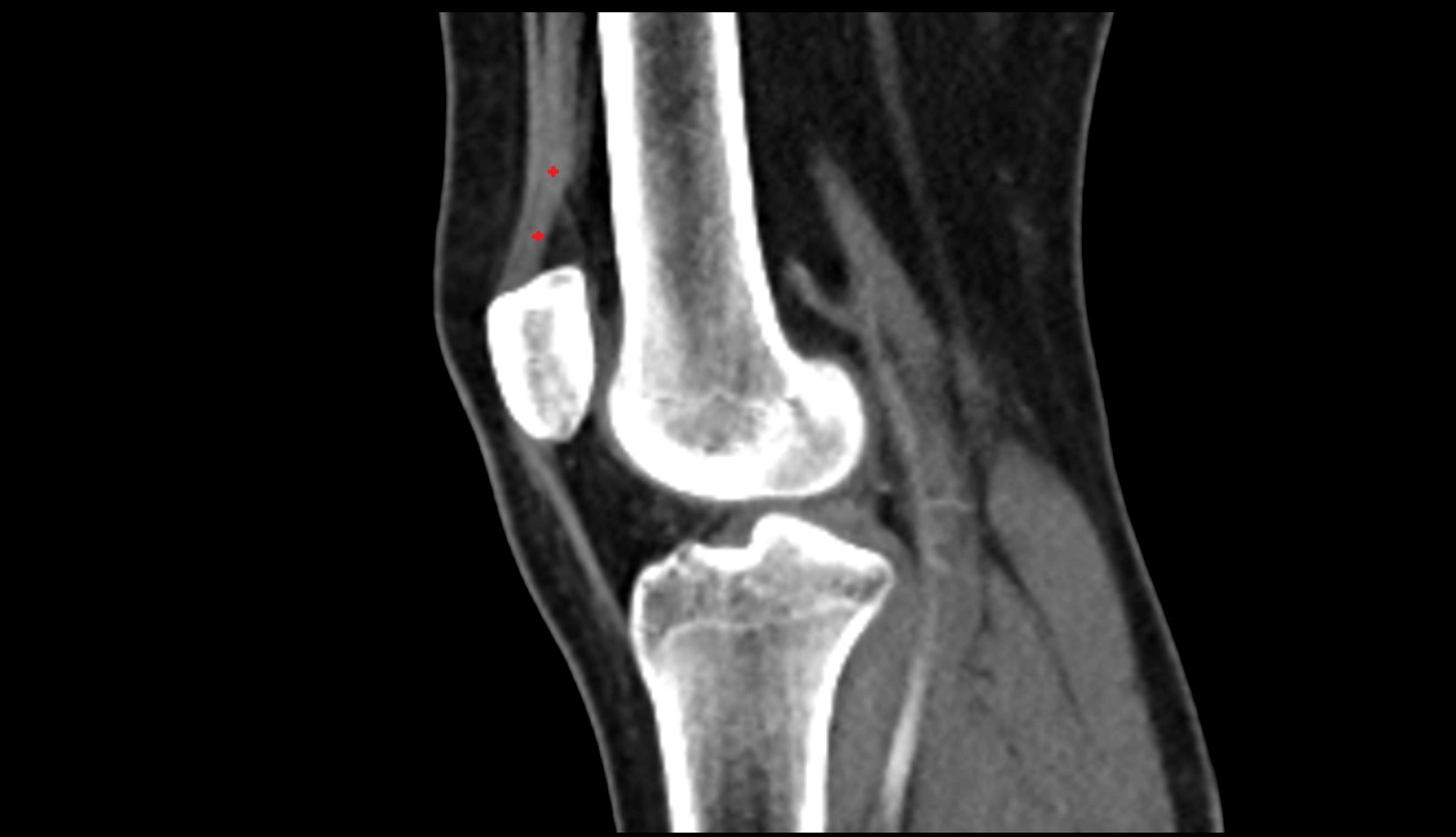 Distal vastus intermedius tendon ct sagittal image