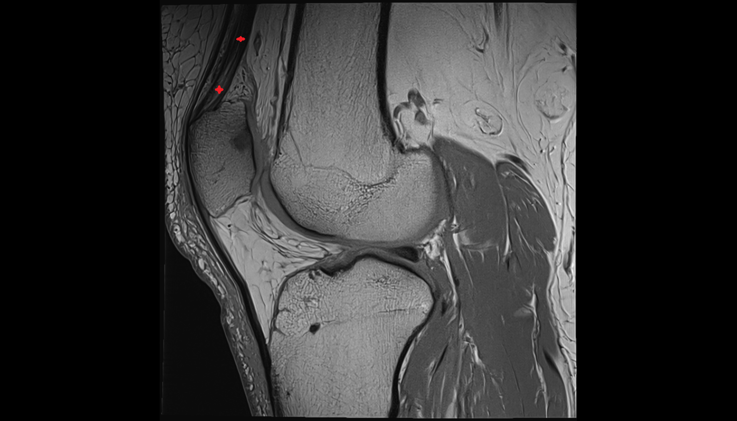 Distal vastus intermedius tendon sagittal  cross sectional anatomy 3T MRI AI enhanced  radiology  anatomy image-img-00000-00000