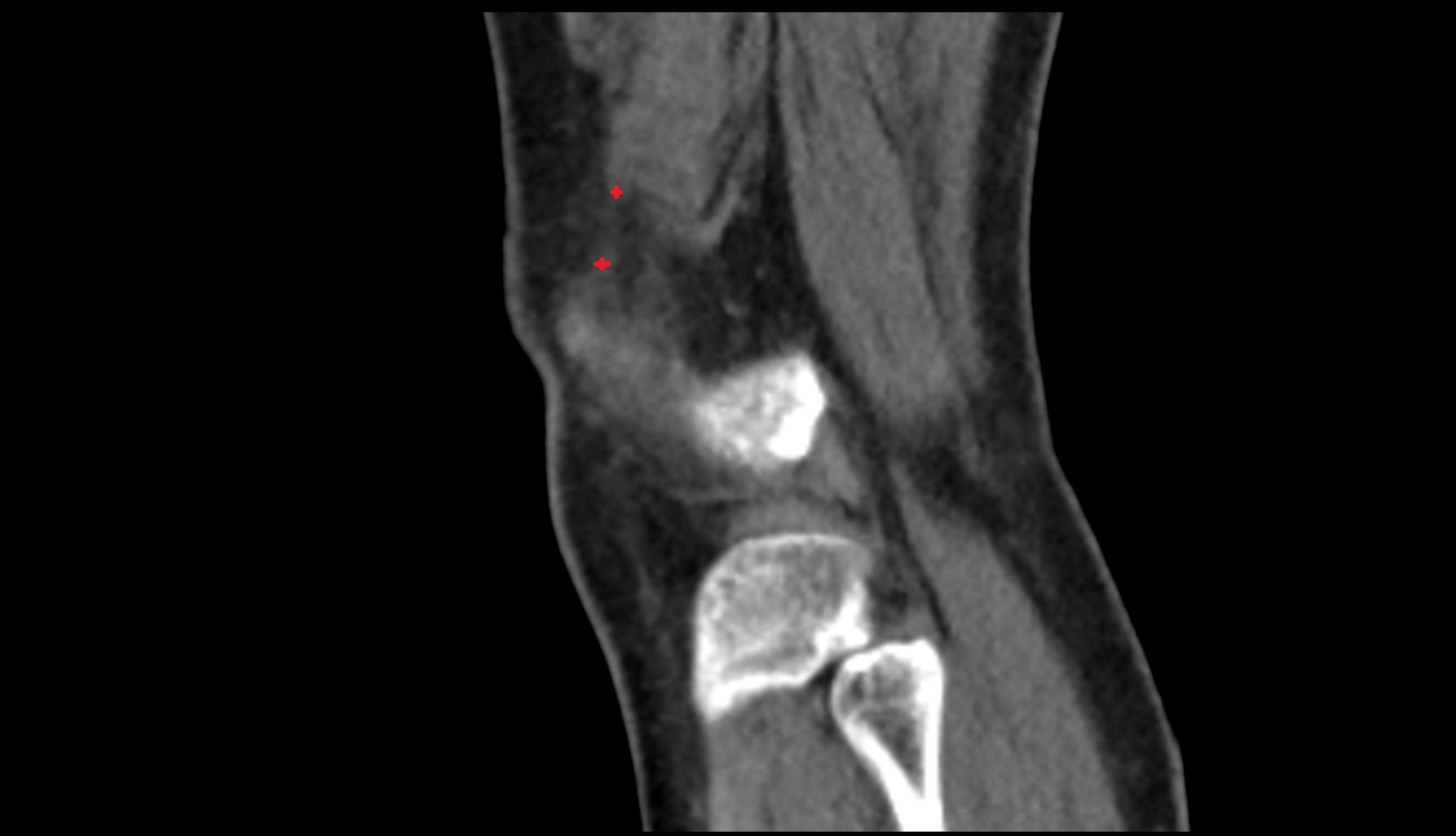 Distal vastus lateralis tendon CT sagittal image