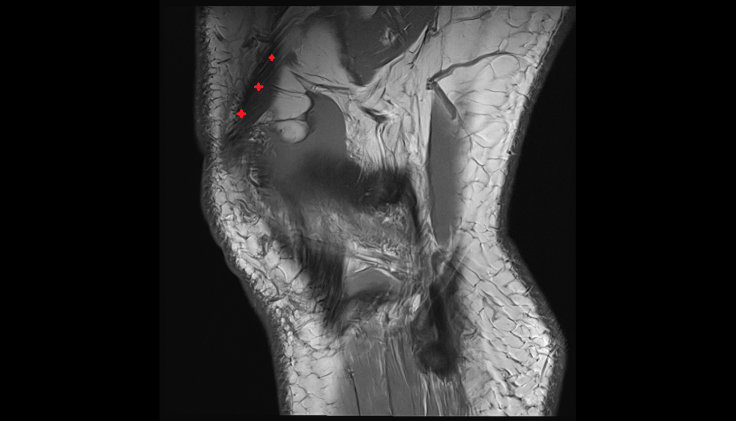 Distal vastus lateralis tendon sagittal  cross sectional anatomy 3T MRI AI enhanced  radiology  anatomy image-img-00000-00000_00001