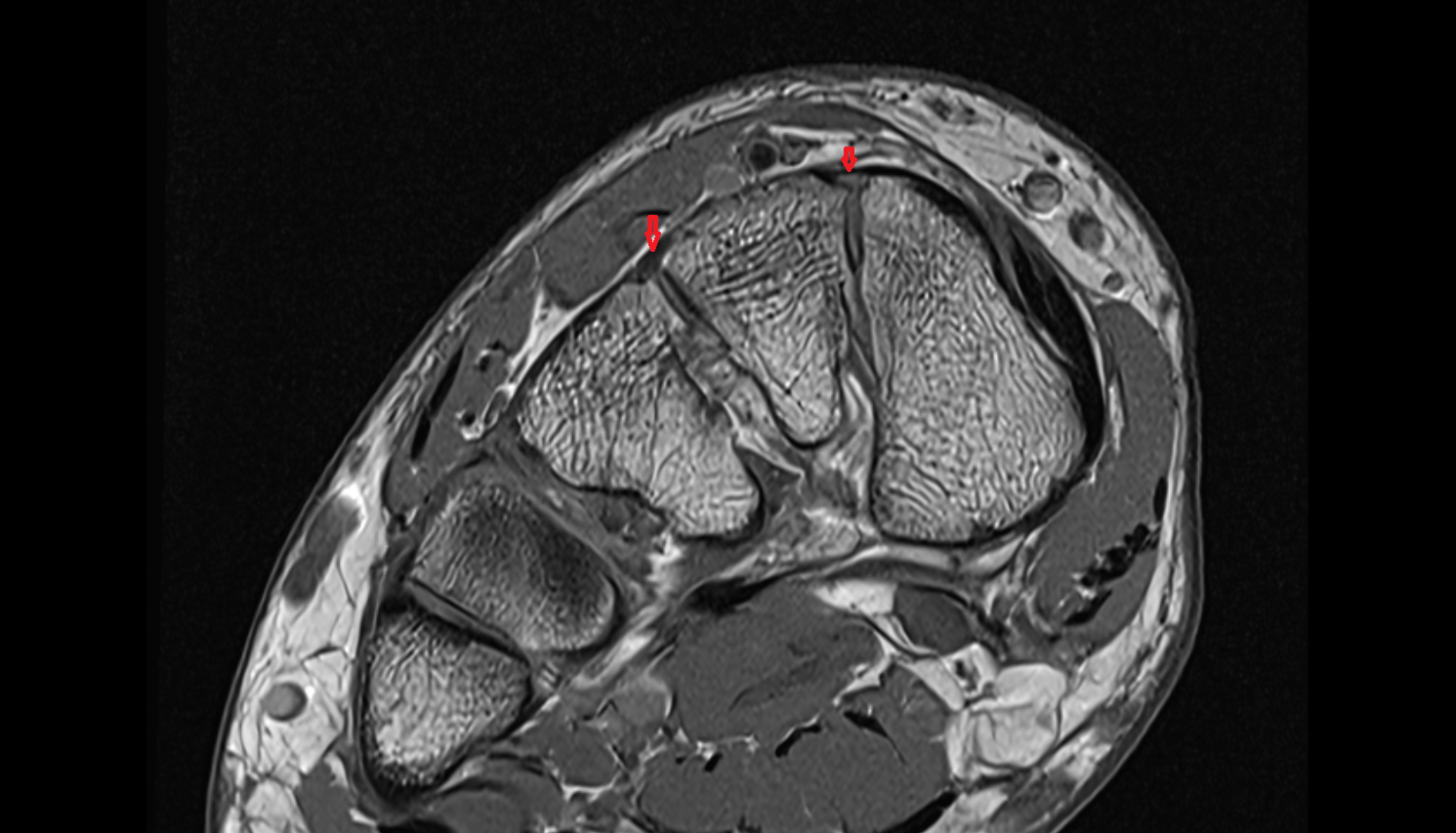 Dorsal Intercuneiform Ligamentsl axial cross sectional anatomy 3T MRI AI enhanced radiology image-img-00000-00000
