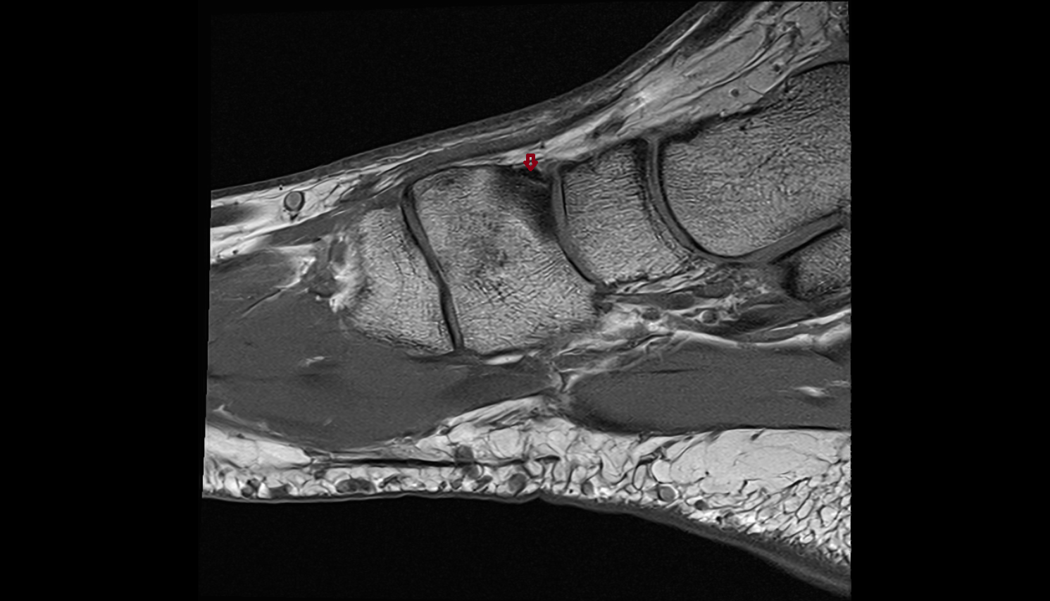 Dorsal Intercuneiform Ligamentsl sag cross sectional anatomy 3T MRI AI enhanced radiology image-img-00000-00000