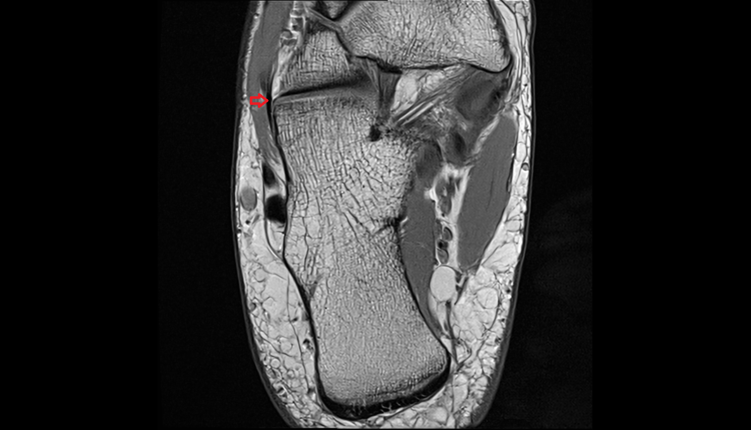 Dorsal calcaneocuboid ligament  axial cross sectional anatomy 3T MRI AI enhanced radiology image-img-00000-00000
