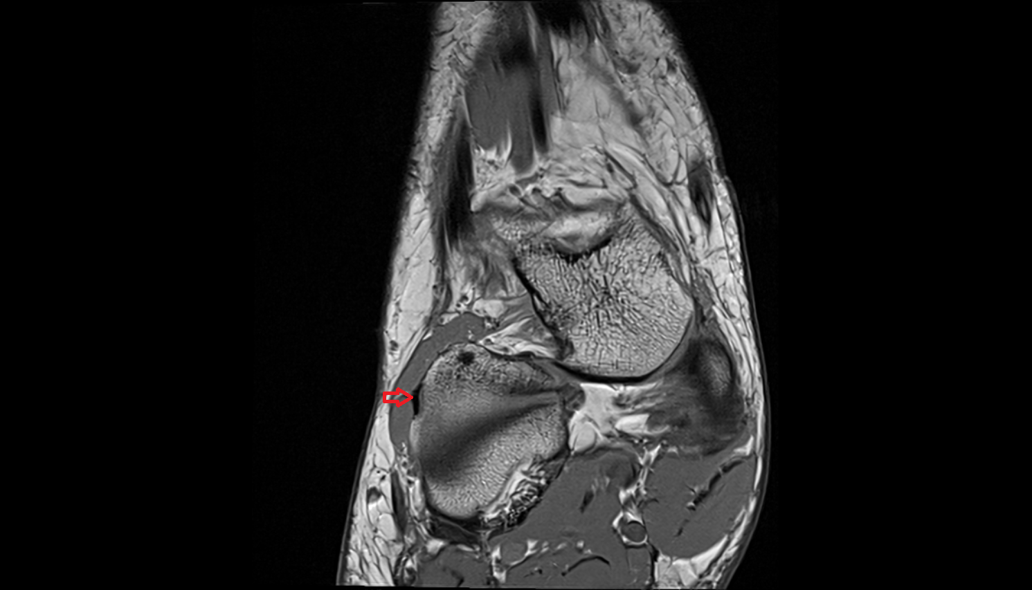 Dorsal calcaneocuboid ligament coronal  cross sectional anatomy 3T MRI AI enhanced radiology image-img-00000-00000